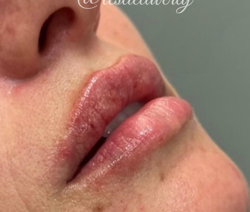 Lips Before & After Gallery - Patient 55501384 - Image 2