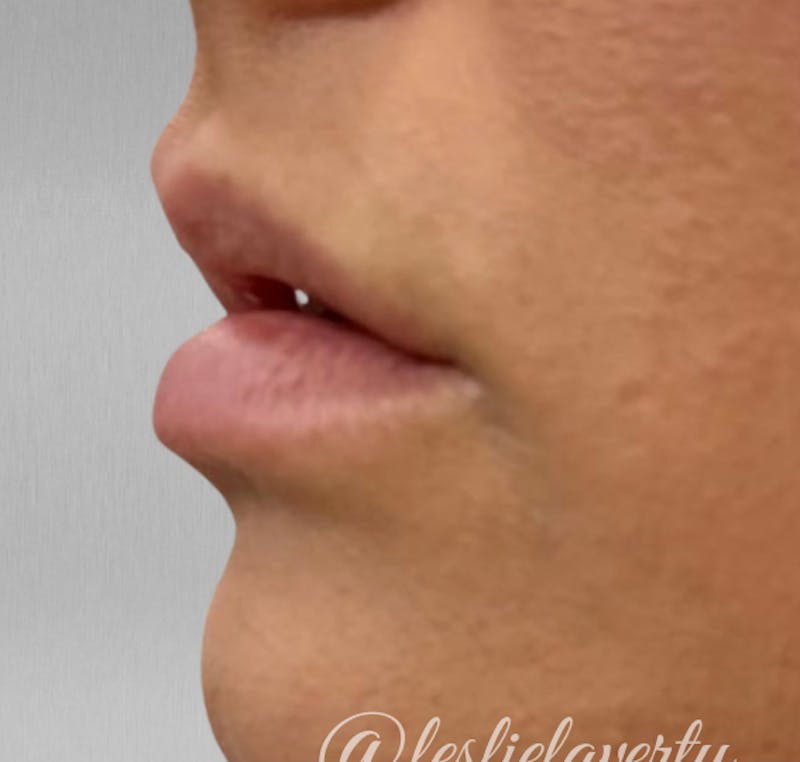 Lips Before & After Gallery - Patient 55501385 - Image 1