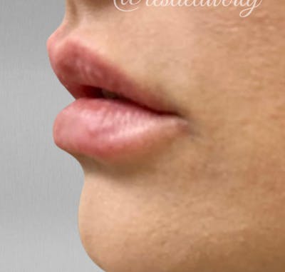 Lips Before & After Gallery - Patient 55501385 - Image 2