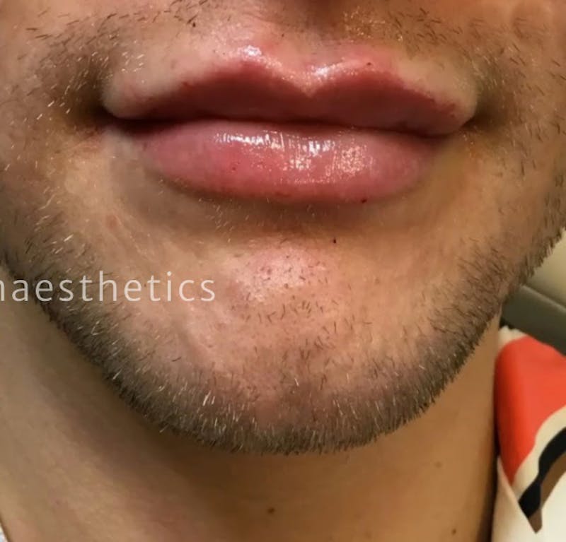 Lips Before & After Gallery - Patient 55501386 - Image 2