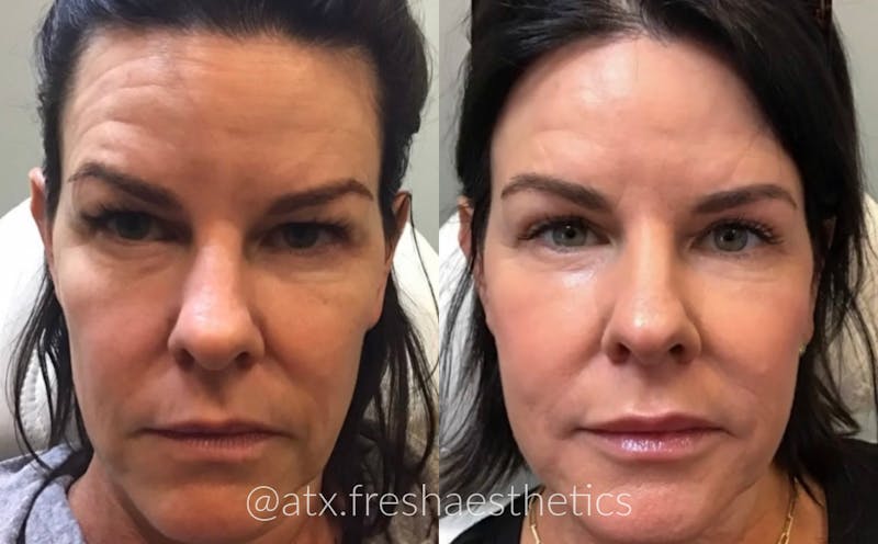 Sculptra Before & After Gallery - Patient 55703244 - Image 1