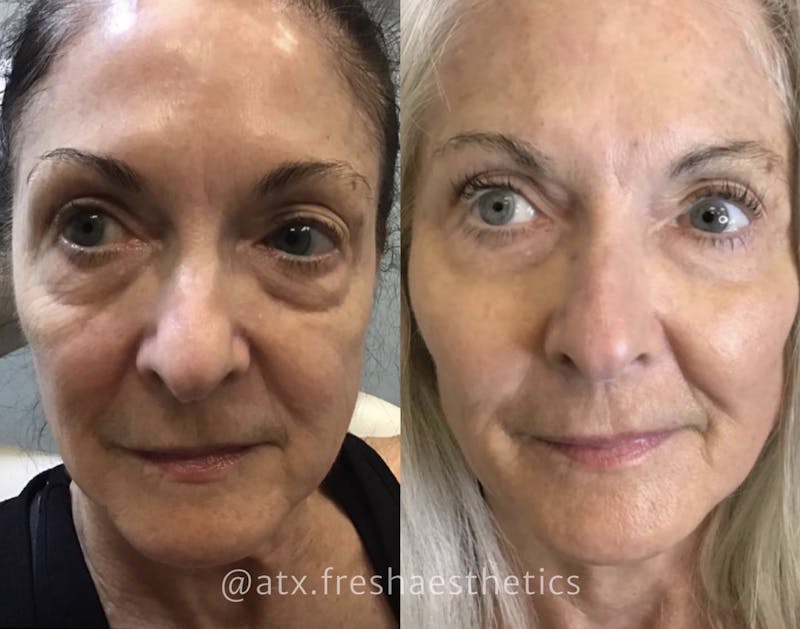Sculptra Before & After Gallery - Patient 55703243 - Image 1