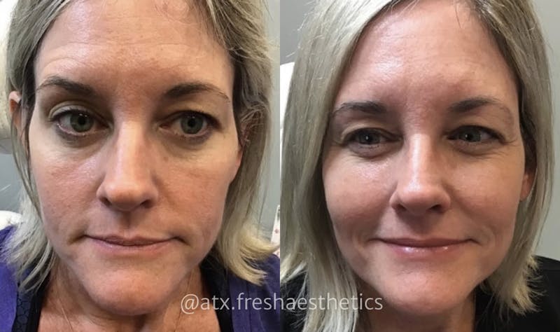 Sculptra Before & After Gallery - Patient 55703242 - Image 1