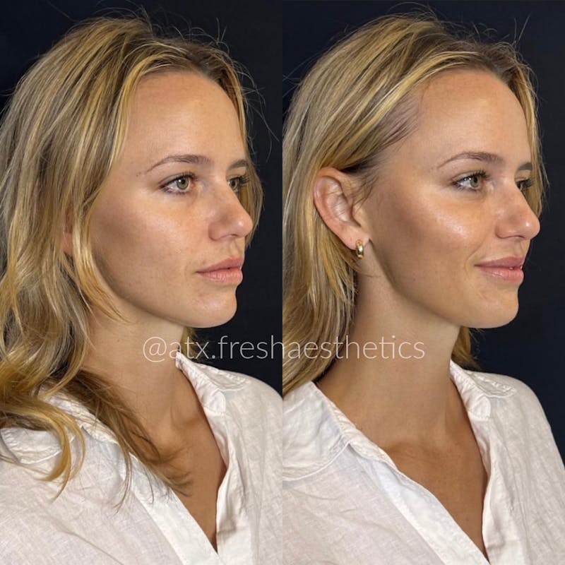 Sculptra Before & After Gallery - Patient 55703241 - Image 1