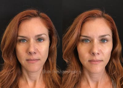 Sculptra Before & After Gallery - Patient 55703240 - Image 1