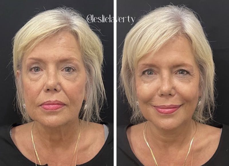 Liquid Facelift Before & After Gallery - Patient 55703266 - Image 1
