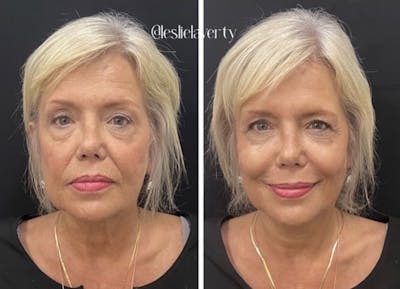 Liquid Facelift Before & After Gallery - Patient 55703266 - Image 1
