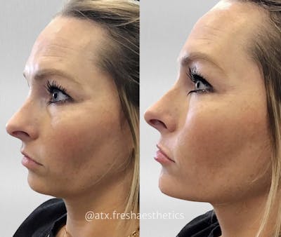 Liquid Facelift Before & After Gallery - Patient 55703265 - Image 1