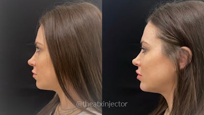 Liquid Facelift Before & After Gallery - Patient 55703264 - Image 1