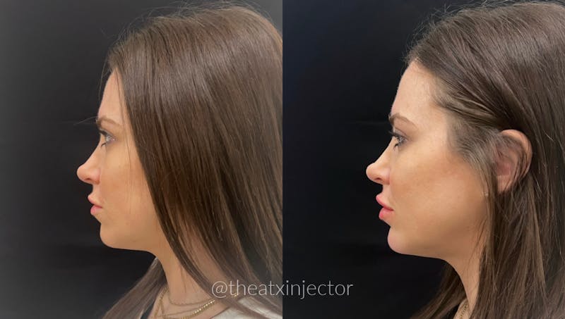 Liquid Facelift Before & After Gallery - Patient 55703264 - Image 1