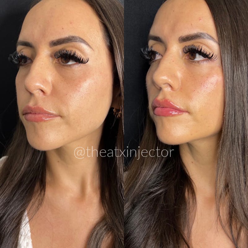 Liquid Facelift Before & After Gallery - Patient 55703263 - Image 1