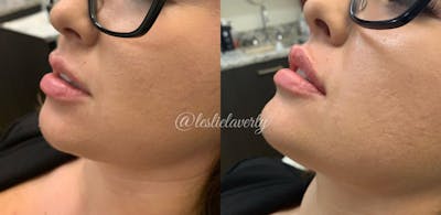 Lips Before & After Gallery - Patient 55703286 - Image 1