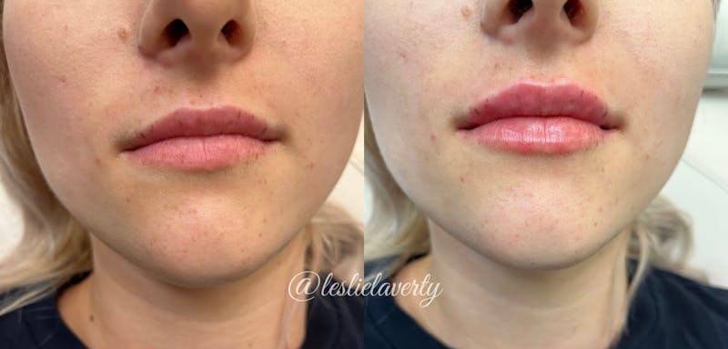Lips Before & After Gallery - Patient 55703285 - Image 1