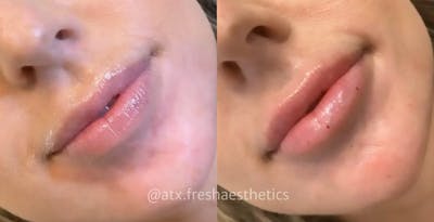 Lips Before & After Gallery - Patient 55703284 - Image 1