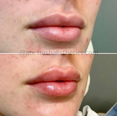 Lips Before & After Gallery - Patient 55703283 - Image 1
