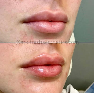 Lips Before & After Gallery - Patient 55703283 - Image 1