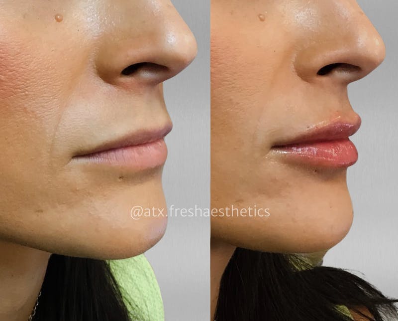 Lips Before & After Gallery - Patient 55703282 - Image 1