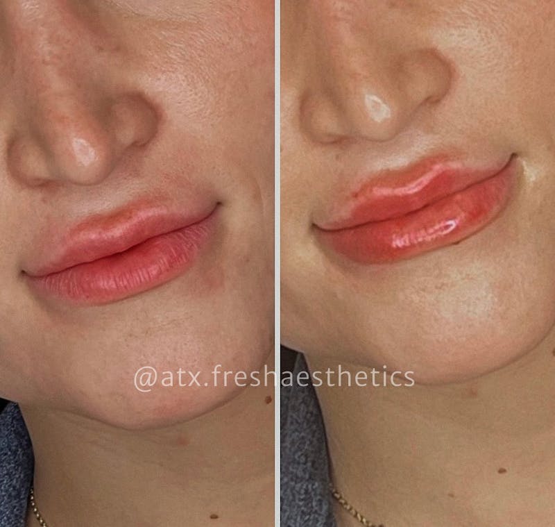 Lips Before & After Gallery - Patient 55703281 - Image 1