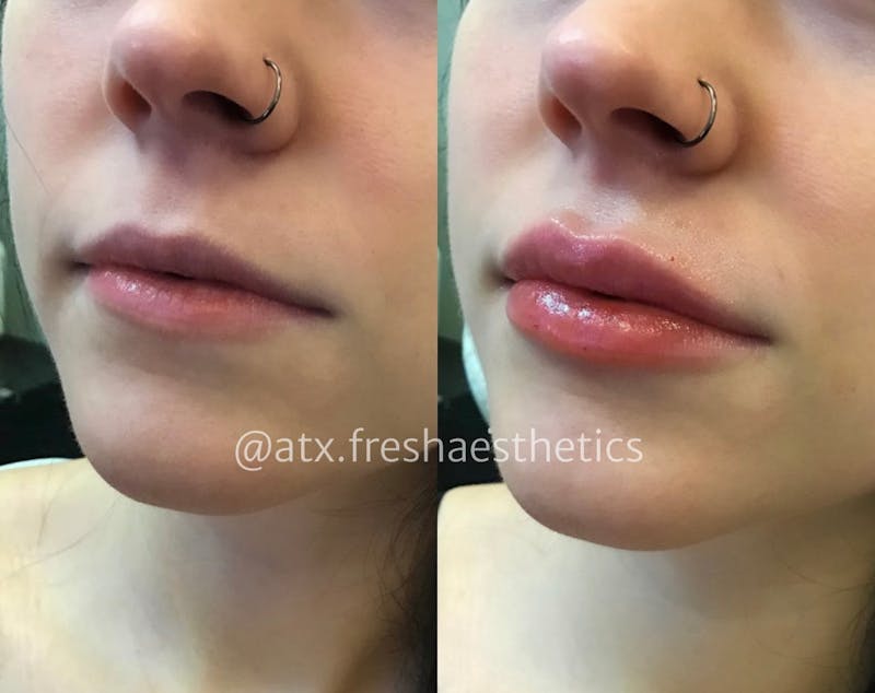 Lips Before & After Gallery - Patient 55703280 - Image 1