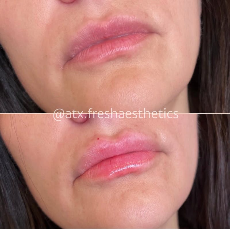 Lips Before & After Gallery - Patient 55703279 - Image 1