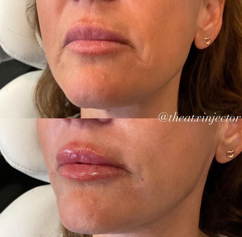 Lips Before & After Gallery - Patient 55703277 - Image 1