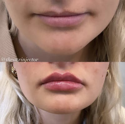 Lips Before & After Gallery - Patient 55703276 - Image 1