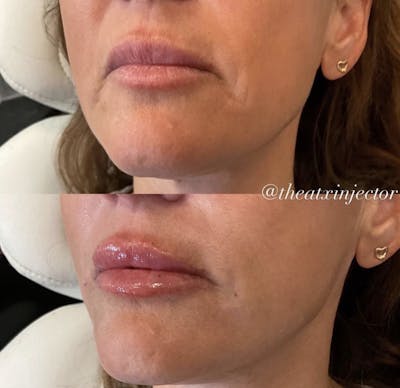Lips Before & After Gallery - Patient 55703275 - Image 1