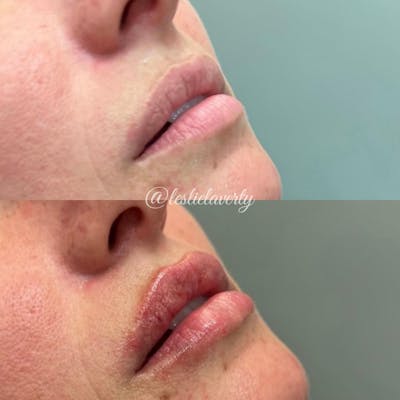 Lips Before & After Gallery - Patient 55703274 - Image 1