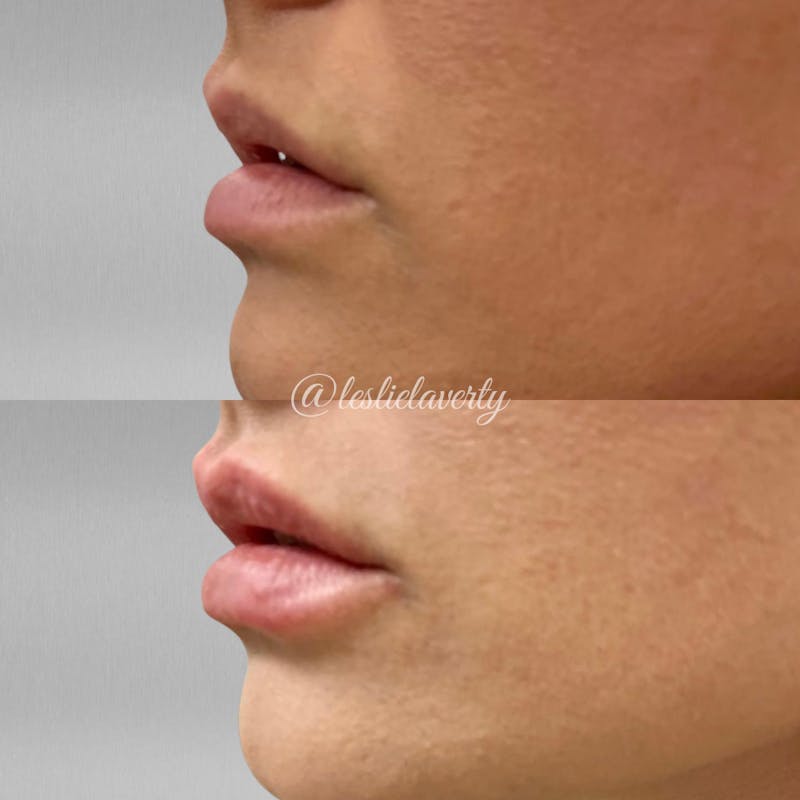 Lips Before & After Gallery - Patient 55703273 - Image 1