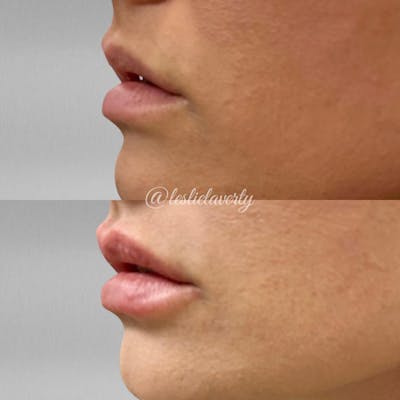 Lips Before & After Gallery - Patient 55703273 - Image 1