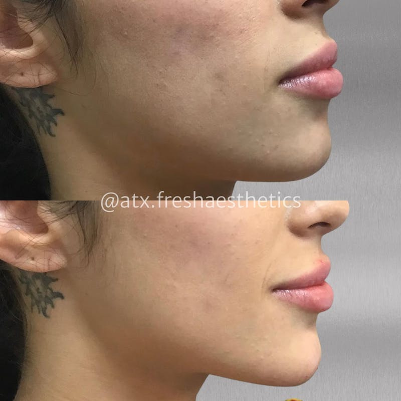 Jaw & Chin Filler Before & After Gallery - Patient 55703293 - Image 1