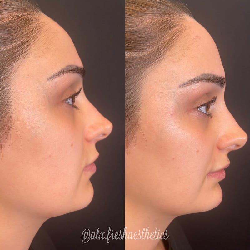 Jaw & Chin Filler Before & After Gallery - Patient 55703292 - Image 1