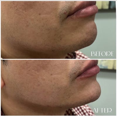 Jaw & Chin Filler Before & After Gallery - Patient 55703291 - Image 1