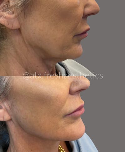 Jaw & Chin Filler Before & After Gallery - Patient 55703290 - Image 1
