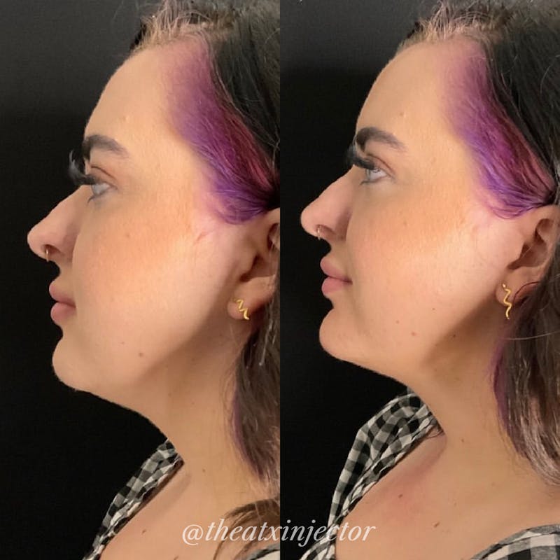Jaw & Chin Filler Before & After Gallery - Patient 55703289 - Image 1