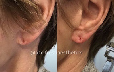 Ear Rejuvenation Before & After Gallery - Patient 55703294 - Image 1