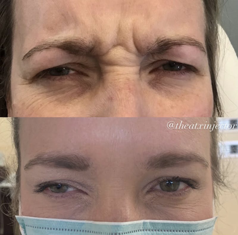 BOTOX & Dysport Before & After Gallery - Patient 55703311 - Image 1