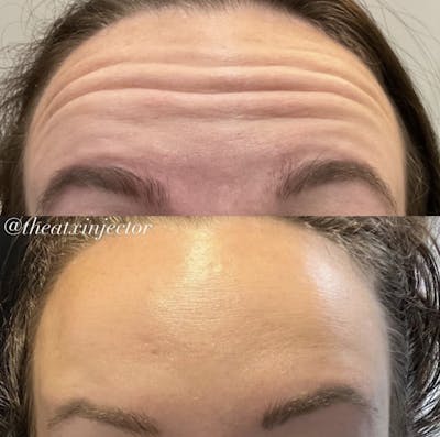 BOTOX & Dysport Before & After Gallery - Patient 55703310 - Image 1