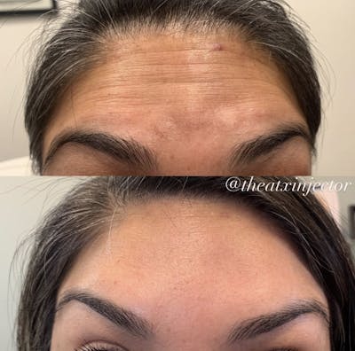 BOTOX & Dysport Before & After Gallery - Patient 55703309 - Image 1