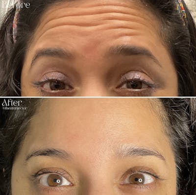 BOTOX & Dysport Before & After Gallery - Patient 55703308 - Image 1