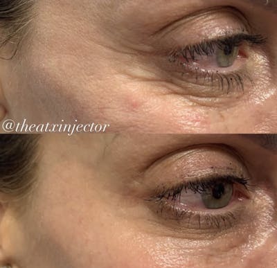 BOTOX & Dysport Before & After Gallery - Patient 55703307 - Image 1