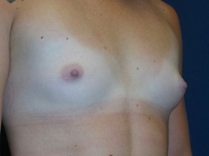 Breast Augmentation by Dr. Haydon Before & After Gallery - Patient 55709026 - Image 1