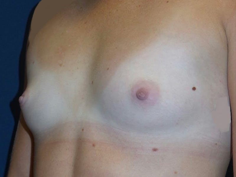Breast Augmentation by Dr. Haydon Before & After Gallery - Patient 55709026 - Image 3