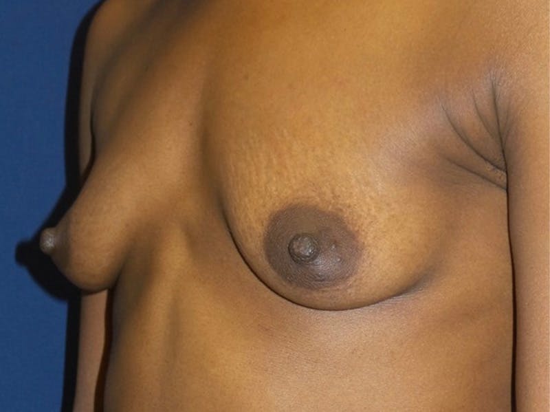 Breast Augmentation by Dr. Haydon Before & After Gallery - Patient 55709028 - Image 1