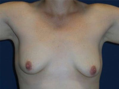 Breast Augmentation by Dr. Haydon Before & After Gallery - Patient 55709027 - Image 1
