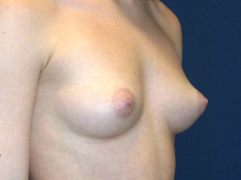 Before & after breast augmentation at Austin Plastic Surgery Institute