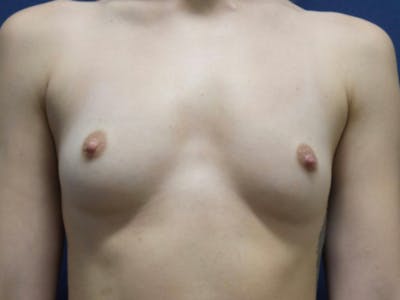 Breast Augmentation by Dr. Haydon Before & After Gallery - Patient 55709030 - Image 1