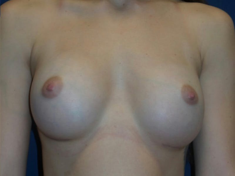 Breast Augmentation by Dr. Haydon Before & After Gallery - Patient 55709030 - Image 2
