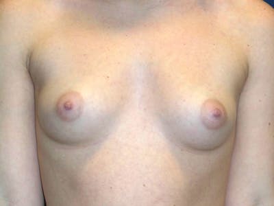 Breast Augmentation by Dr. Haydon Before & After Gallery - Patient 55709032 - Image 1