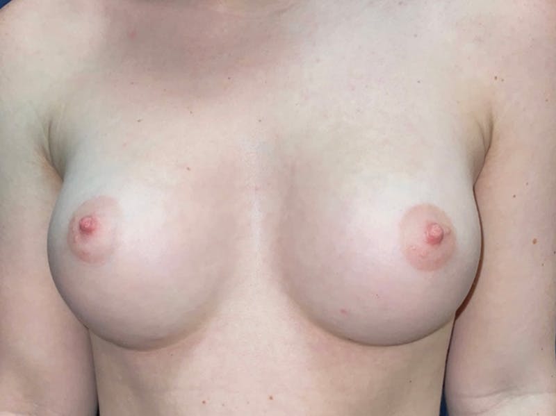 Breast Augmentation by Dr. Haydon Before & After Gallery - Patient 55709032 - Image 2